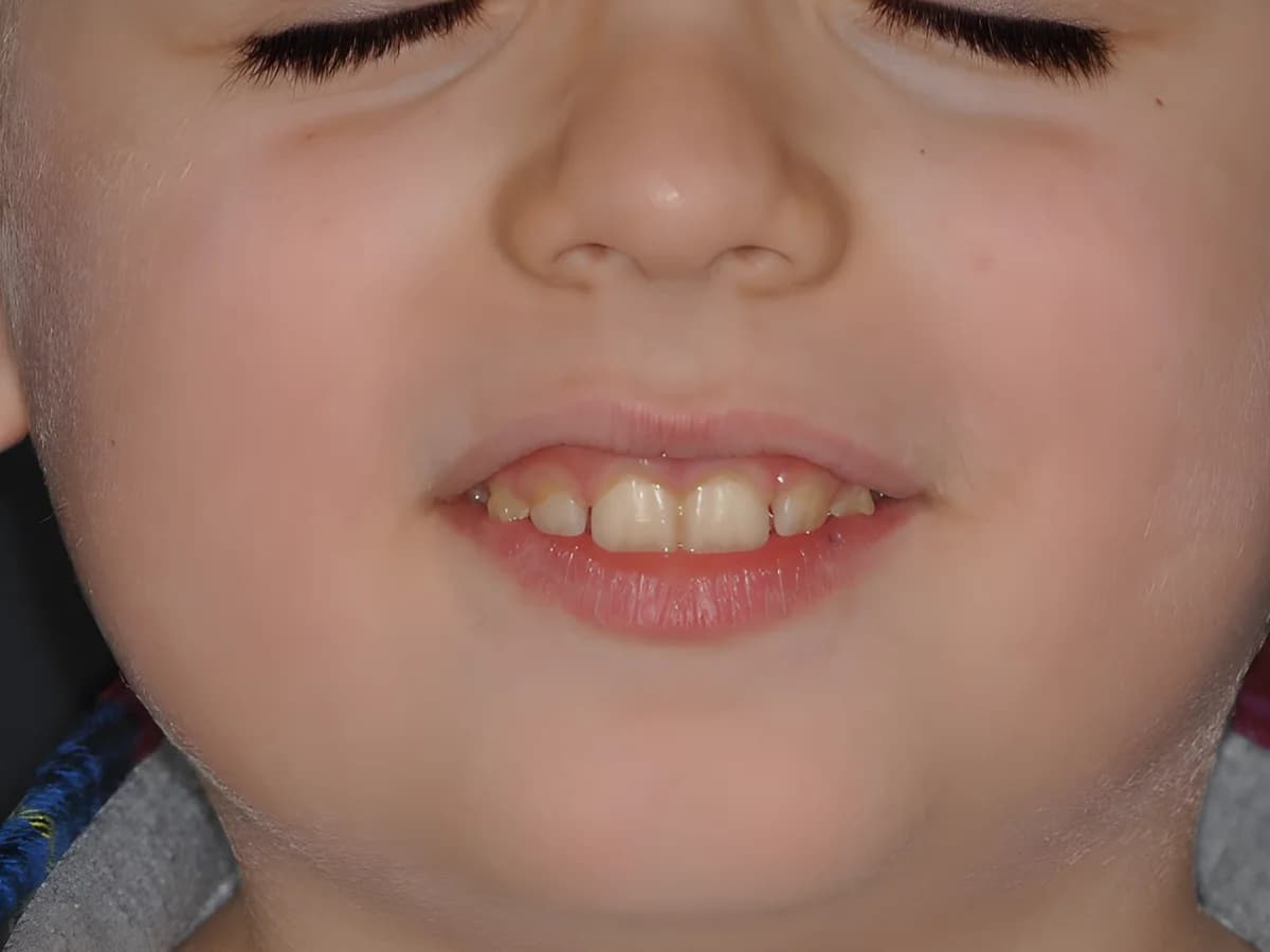 Caso 3, D.M., 7 anni, dopo il trattamento