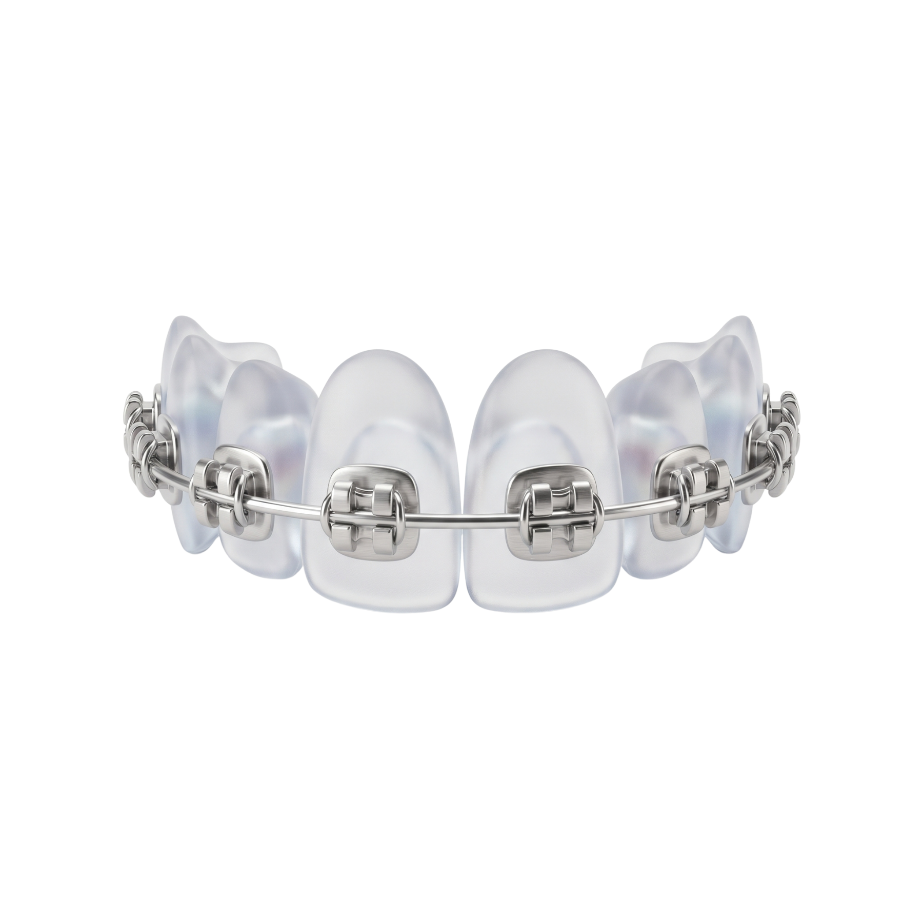 Apparecchio fisso metallico tradizionale con brackets